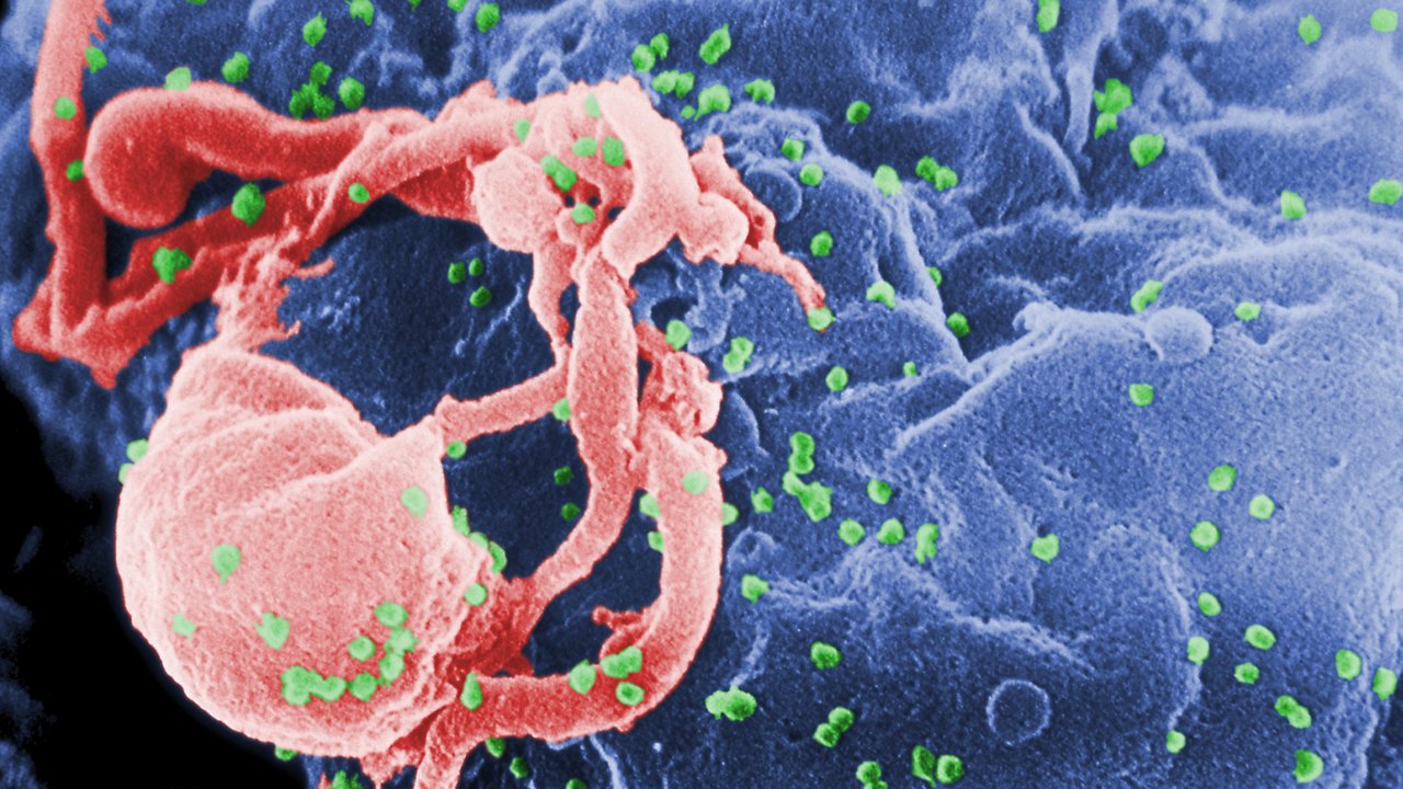 Coloured scanning electron micrograph of green HIV particles budding from a blue lymphocyte.