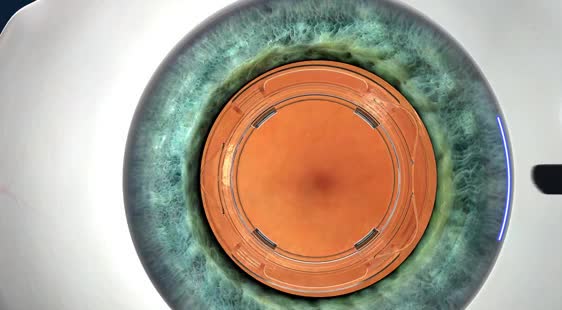 Rendered eye with an implanted lens