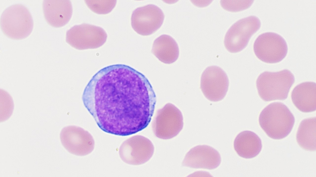 Microscope image of a single large purple-stained leukemia blast cell among pink red blood cells.