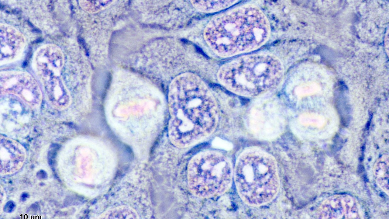 Stained HeLa cells in metaphase and anaphase of mitosis