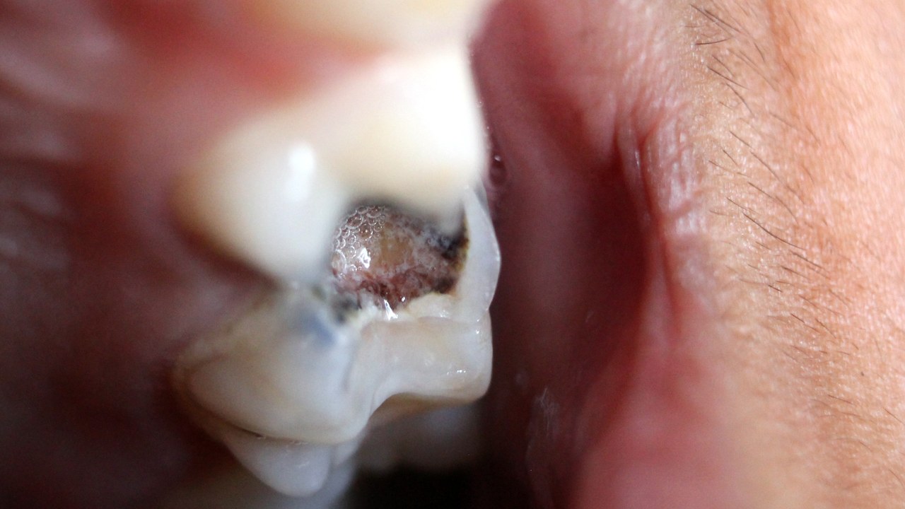 Close-up of a molar with a cavity caused by tooth decay