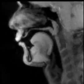 An MRI slice through a mouth and throat.